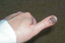 Medical Advice for a Smashed Thumb