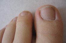 How to Treat Toenail Infection With Apple Cider Vinegar