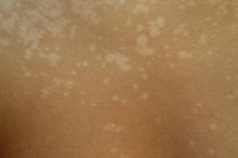 How to Get Rid of Tinea Versicolor (Pityriasis Versicolor) Skin Condition