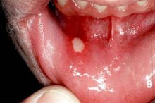 Mouth Ulcer Remedy
