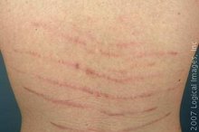 What Causes Stretch Marks On the Lower Back?