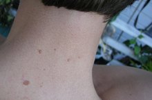 Why Do Skin Moles Increase?