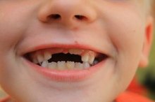Shark Teeth in Children