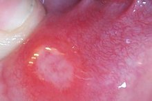 Herpes Stomatitis in Adults