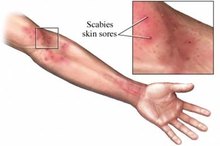 How to Tell if You Have Scabies