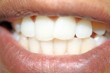 How to Store Partial Dentures for a Long Time