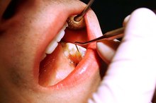 Tooth Pain After a Dental Cleaning