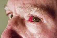 Causes of Broken Eye Blood Vessels