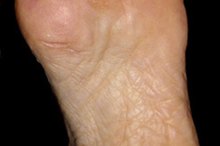 Hypothyroid Foot Pain