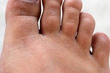 How to Straighten Hammer Toes