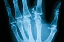 手指骨折后什么时候可以回到正常活动？