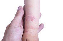 有什么导致儿童发痒的皮肤？