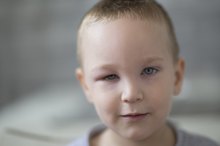 A Swollen Eyelid in a Child