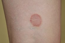 What Happens If Ringworm Is Untreated?