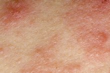 Diseases that Cause Eczema