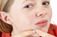 How to Determine if a Face Blemish Is a Wart or Pimple