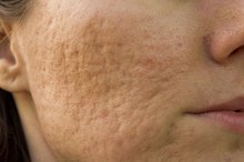 Rosacea and Enlarged Pores
