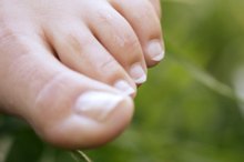 如何矫正大脚趾上向内生长的指甲?