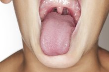Swollen Tonsils Caused by Allergies