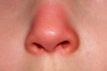 Why Does My Nose Turn Red?