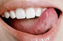 舌头上的溃疡原因