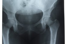 How Do I Relieve a Jammed Hip Joint?