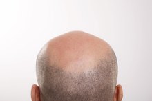 Scalp Conditions That Cause Hair Loss