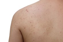 Causes of Acne on the Arms & Back