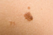 What to Do if a Mole Becomes Itchy & Painful
