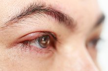 How to Get Rid of Styes in Your Eyelids
