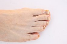 What Are the Causes of Toenail Discoloration?
