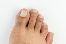 How to Get Rid of Dry Feet & Ugly Toenails