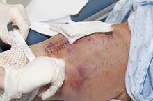 膝关节置换的伤疤