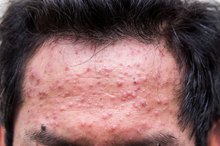 Common Skin Rashes on the Face
