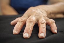 Symptoms of Rheumatoid Arthritis in the Hands and Fingers