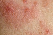 Ringworm & Stress-Related Skin Rashes