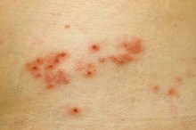 How Is Shingles Diagnosed?