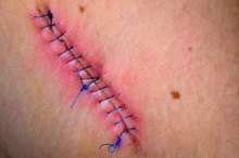 How to Tell If a Suture Scar Is Healing Well