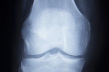 Rehabilitation From Tibial Plateau Knee Surgery