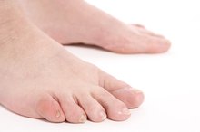 How to Care for a Swollen Toe