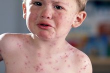 Coughing With a Rash in Children