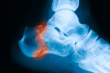 Complications of ORIF Ankle Surgery