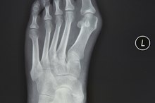 Home Remedies for Fractured Foot Bones