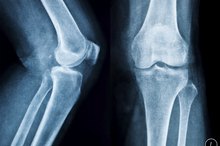 What Are the Treatments for Bone Spurs on the Leg Bone?