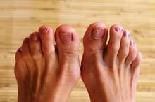 List of Foods That Cause Gout