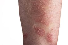 Does B12 Help Psoriasis?