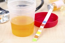 How to Interpret Dipstick Urinalysis Results