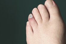 How to Help Heal a Broken Toe