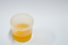 Is a Urine Protein Level of 234.0 High?