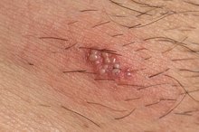 Treatment for Shingles Blisters